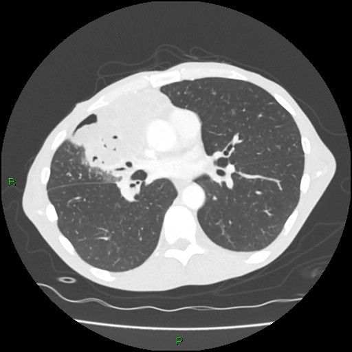 Acute right lung abscess (Radiopaedia 34806-36258 Axial lung window 100).jpg