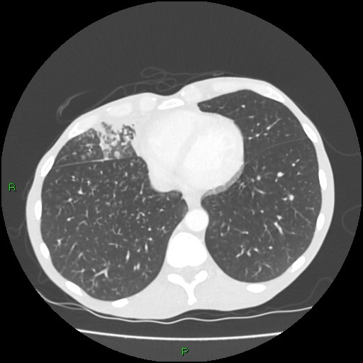 Acute right lung abscess (Radiopaedia 34806-36258 Axial lung window 140).jpg