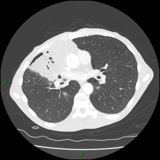 Acute right lung abscess (Radiopaedia 34806-36258 Axial lung window 97).jpg