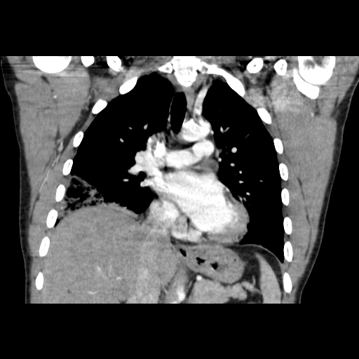 Acute segmental pulmonary emboli and pulmonary infarction (Radiopaedia 62264-70444 Coronal C+ CTPA 25).jpg