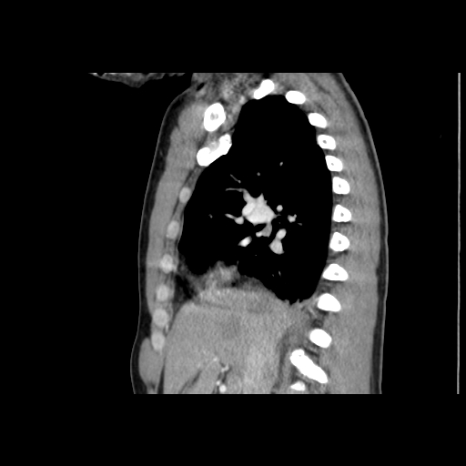 File:Acute segmental pulmonary emboli and pulmonary infarction (Radiopaedia 62264-70444 Sagittal C+ CTPA 26).jpg