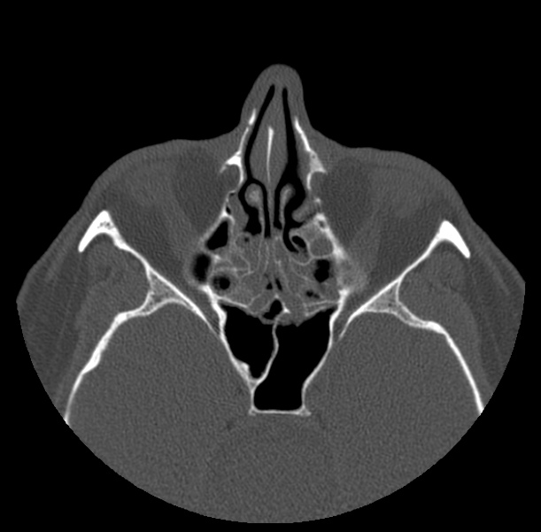 Acute sinusitis (Radiopaedia 23161-23215 Axial bone window 38).jpg