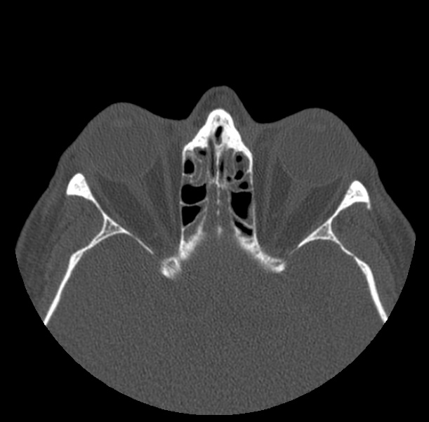 Acute sinusitis (Radiopaedia 23161-23215 Axial bone window 50).jpg