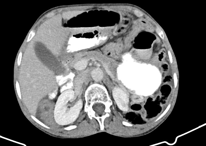 Acute small bowel (ileal) volvulus (Radiopaedia 71740-82139 Axial C+ portal venous phase 69).jpg