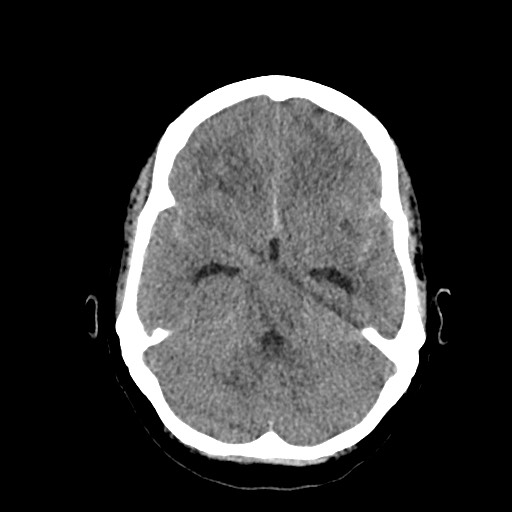 Acute subarachnoid hemorrhage and accessory anterior cerebral artery (Radiopaedia 69231-79008 Axial non-contrast 19).jpg