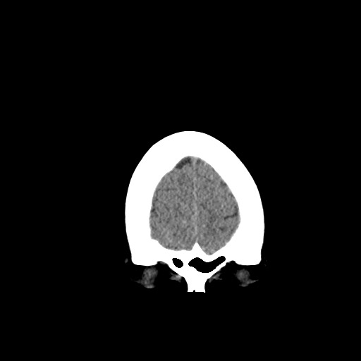 Acute subarachnoid hemorrhage and accessory anterior cerebral artery (Radiopaedia 69231-79008 Coronal non-contrast 11).jpg