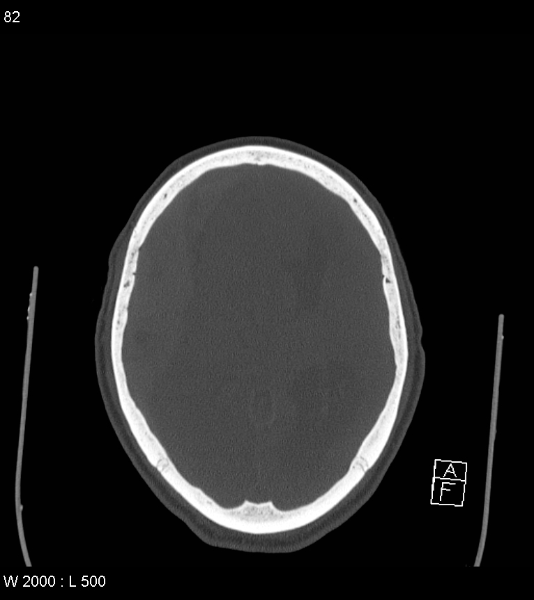 Acute subdural hematoma with myelofibrosis (Radiopaedia 52582-58494 Axial bone window 41).jpg