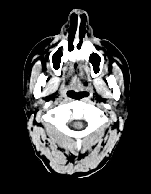 Acute superior cerebellar artery territory infarct (Radiopaedia 84104-99359 Axial non-contrast 69).jpg