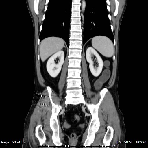 Acute superior mesenteric artery occlusion (Radiopaedia 43636-47060 Coronal C+ portal venous phase 43).jpg
