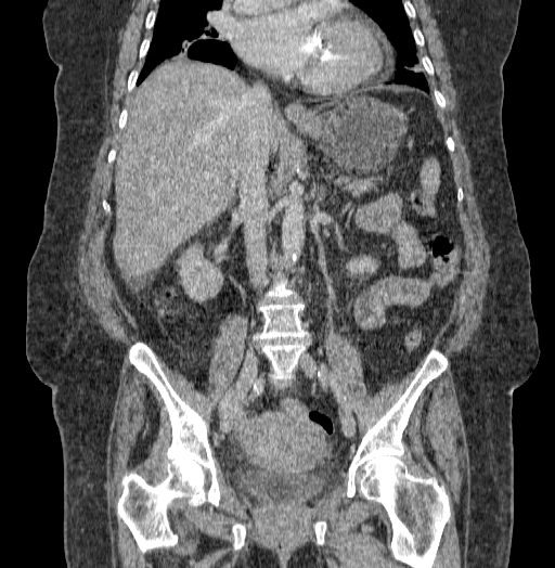 Acute superior mesenteric artery occlusion (Radiopaedia 51288-56960 Coronal C+ portal venous phase 44).jpg