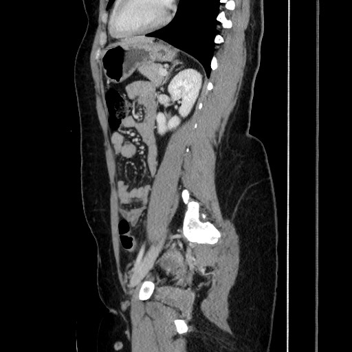 Acute uncomplicated appendicitis (Radiopaedia 73704-84499 Sagittal C+ portal venous phase 134).jpg