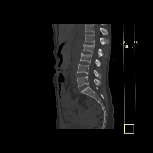 File:Acute vertebral compression fracture (Radiopaedia 63832-72559 Sagittal bone window 12).jpg