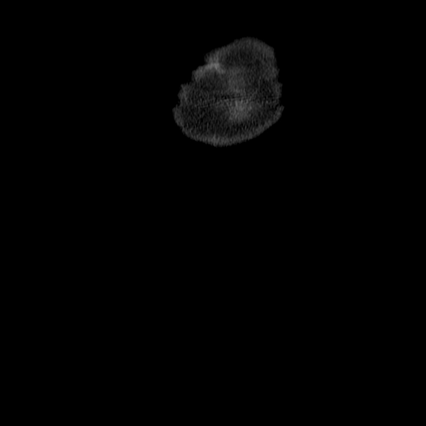 Adenocarcinoma of colon with entero-colic fistula (Radiopaedia 22832-22852 Coronal C+ portal venous phase 1).jpg