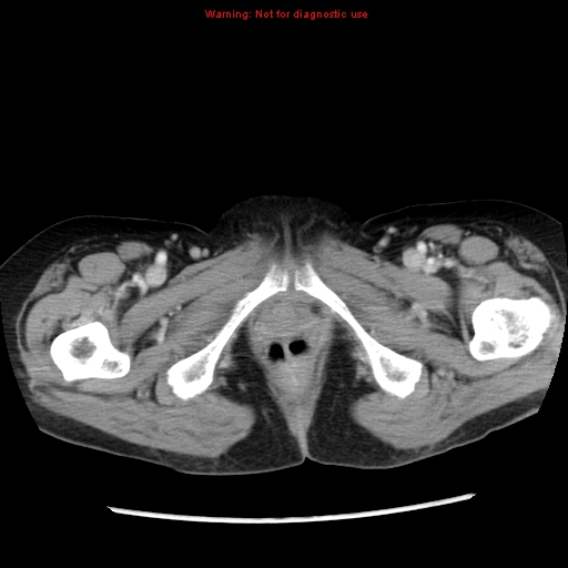 Adenocarcinoma of the colon (Radiopaedia 8191-9039 Axial liver window 79).jpg