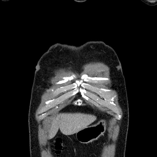 Adenocarcinoma of the lung (Radiopaedia 59871-67325 Coronal C+ arterial phase 2).jpg