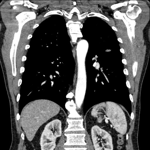 Adenocarcinoma of the lung (Radiopaedia 59871-67325 Coronal C+ arterial phase 47).jpg