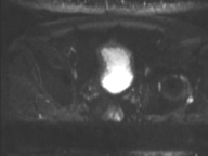 Adenocarcioma of rectum- T1 lesion (Radiopaedia 36921-38546 Axial DWI 16).png