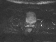 Adenocarcioma of rectum- T1 lesion (Radiopaedia 36921-38546 Axial DWI 42).png