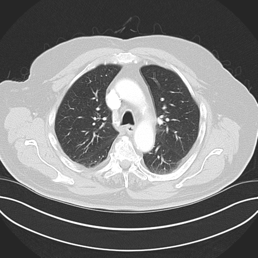 Adenocarcioma of rectum- T1 lesion (Radiopaedia 36921-38547 Axial lung window 21).png