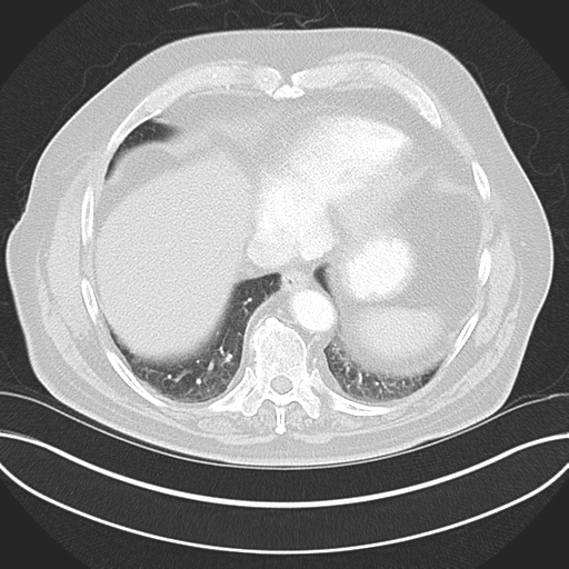 Adenocarcioma of rectum- T1 lesion (Radiopaedia 36921-38547 Axial lung window 43).png