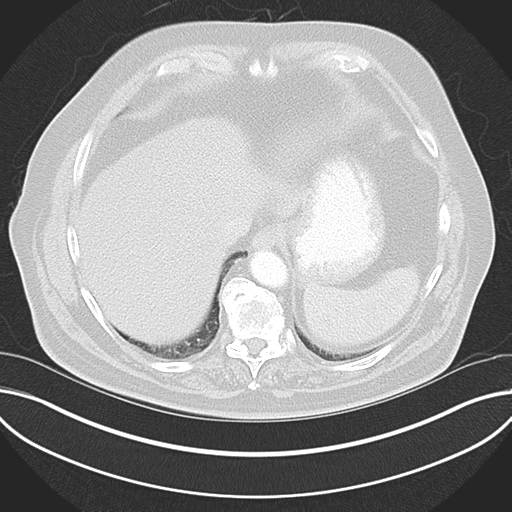 Adenocarcioma of rectum- T1 lesion (Radiopaedia 36921-38547 Axial lung window 46).png