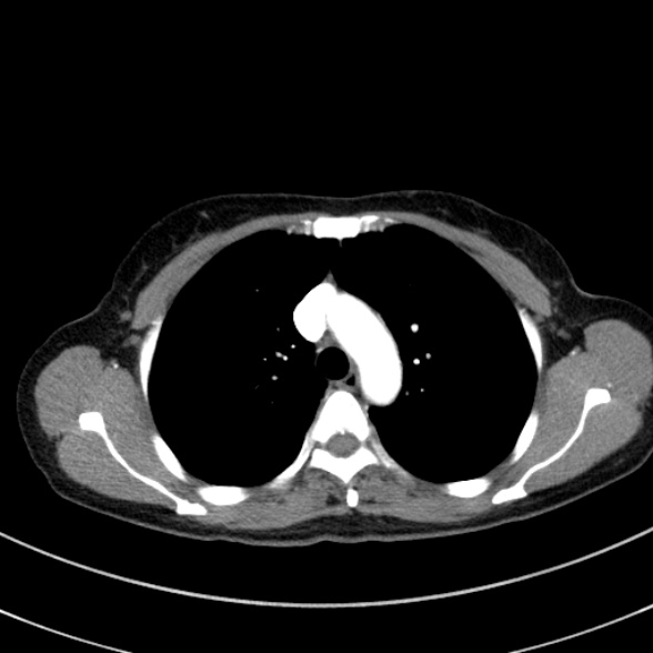 Adenocystic carcinoma of the trachea (Radiopaedia 47677-52525 Axial C+ arterial phase 42).jpg