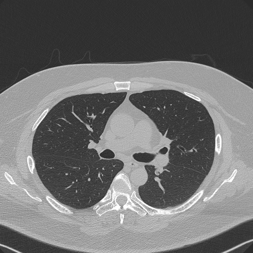 File:Adenoid cystic carcinoma of the trachea (Radiopaedia 49042-54137 Axial lung window 148).jpg