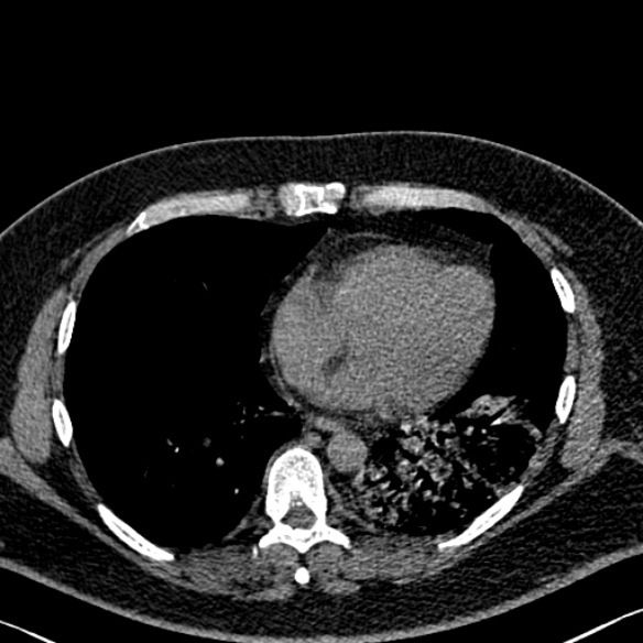 Adenoid cystic carcinoma of the trachea (Radiopaedia 49042-54137 Axial non-contrast 230).jpg