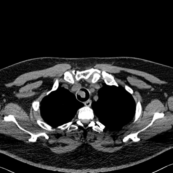 Adenoid cystic carcinoma of the trachea (Radiopaedia 49042-54137 Axial non-contrast 53).jpg