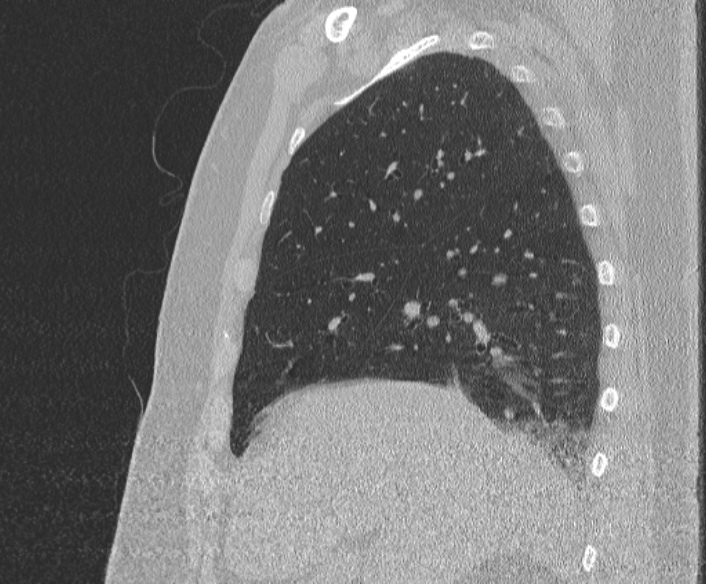 Adenoid cystic carcinoma of the trachea (Radiopaedia 49042-54137 Sagittal lung window 139).jpg