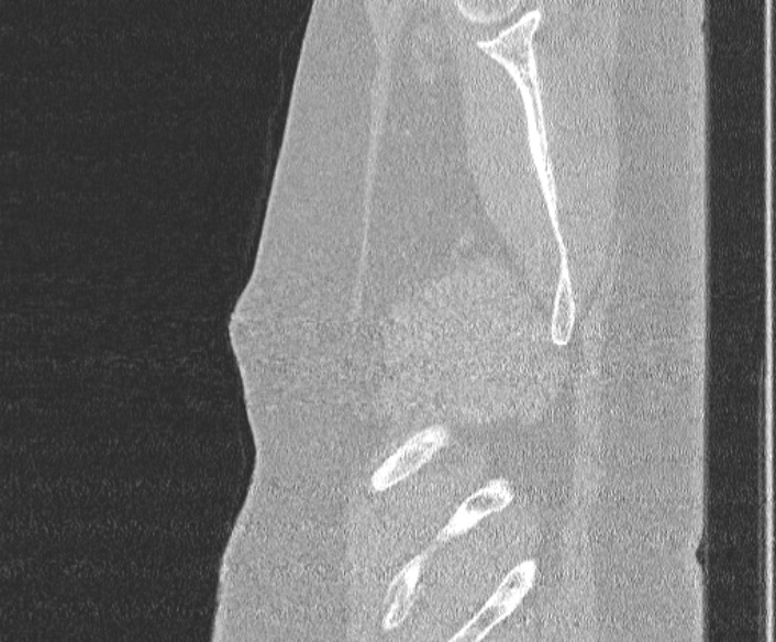 Adenoid cystic carcinoma of the trachea (Radiopaedia 49042-54137 Sagittal lung window 19).jpg