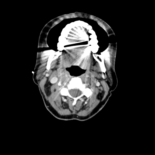 File:Adenoid cystic tumor of palate (Radiopaedia 46980-51518 Axial C+ delayed 34).png