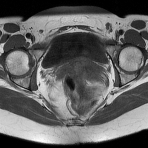 File:Adenoma malignum of cervix (Radiopaedia 66441-75705 Axial T1 12).jpg