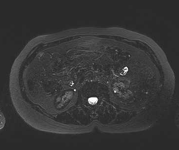 File:Adenomyomatosis of the gallbladder (Radiopaedia 50246-55587 Axial 13).png