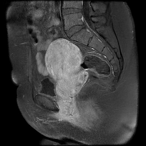 File:Adenomyosis-scar endometriosis (Radiopaedia 65863-75022 Sagittal T1 C+ fat sat 14).jpg