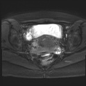 File:Adenomyosis and endometriotic cysts (Radiopaedia 82300-96367 Axial DWI 7).jpg