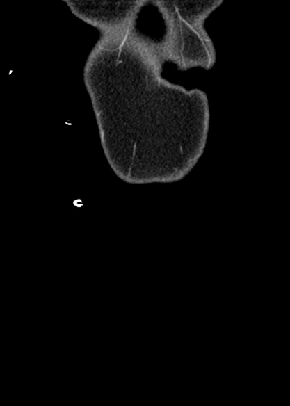Adhesional small bowel obstruction (Radiopaedia 48397-53305 Coronal C+ portal venous phase 10).jpg
