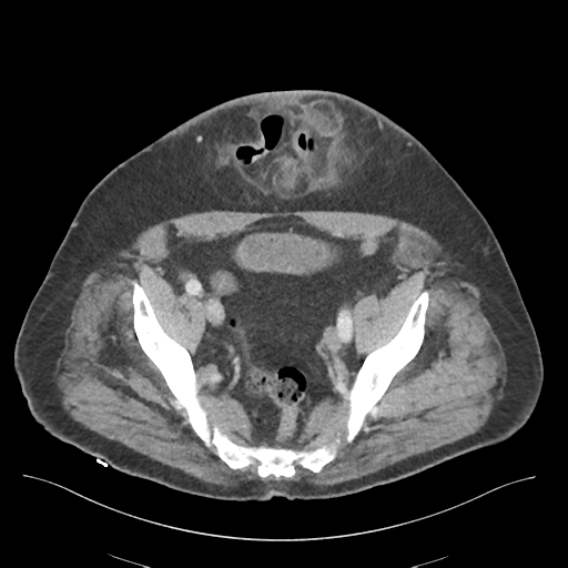 File:Adhesions within abdominal wall hernia (Radiopaedia 58283-65394 Axial C+ portal venous phase 69).png