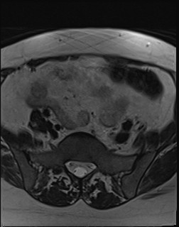 File:Adnexal multilocular cyst (O-RADS US 3- O-RADS MRI 3) (Radiopaedia 87426-103754 Axial T2 3).jpg