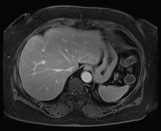 Adrenal cortical carcinoma (Radiopaedia 64017-72770 J 12).jpg