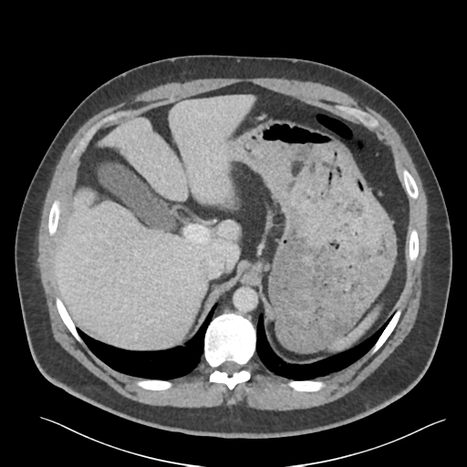 File:Adrenal cyst (Radiopaedia 45625-49777 Axial C+ portal venous phase 28).png