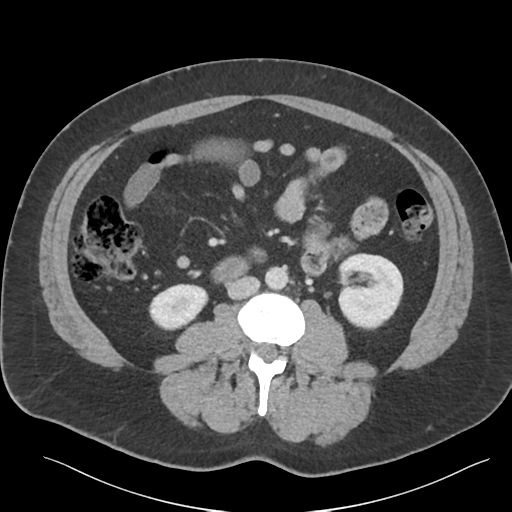 File:Adrenal cyst (Radiopaedia 45625-49777 Axial C+ portal venous phase 54).png