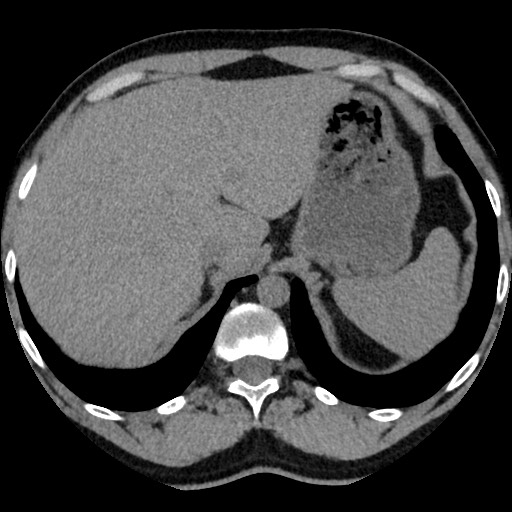 Adrenal gland trauma (Radiopaedia 81351-95079 Axial non-contrast 21).jpg