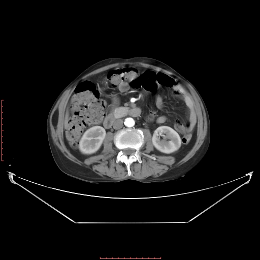 Adrenal hemangioma (Radiopaedia 68923-78668 Axial C+ arterial phase 39).jpg