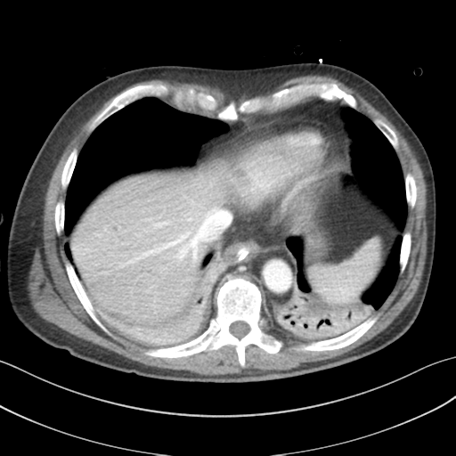 Adrenal hematoma (Radiopaedia 44334-47968 Axial C+ portal venous phase 8).png