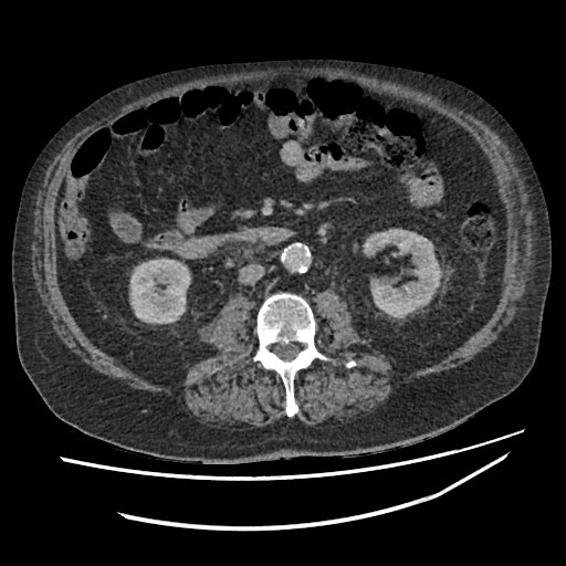 Adrenal lymphoma (Radiopaedia 84145-99415 Axial C+ portal venous phase 70).jpg