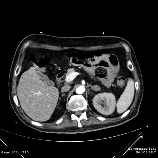 Adrenal metastasis (Radiopaedia 78425-91079 Axial C+ arterial phase 33).jpg