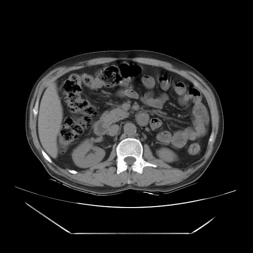 File:Adrenal myelolipoma (Radiopaedia 41843-44834 Axial non-contrast 32).jpg