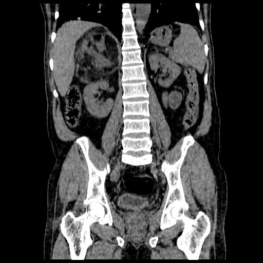 File:Adrenal myelolipoma (Radiopaedia 41843-44834 Coronal non-contrast 12).jpg