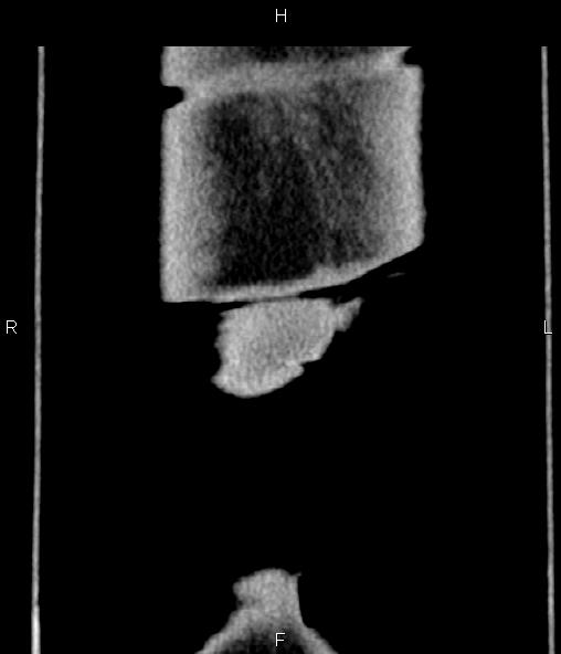 File:Adrenal myelolipoma (Radiopaedia 82742-96986 Coronal renal cortical phase 81).jpg
